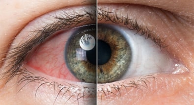 dry eye syndrome image