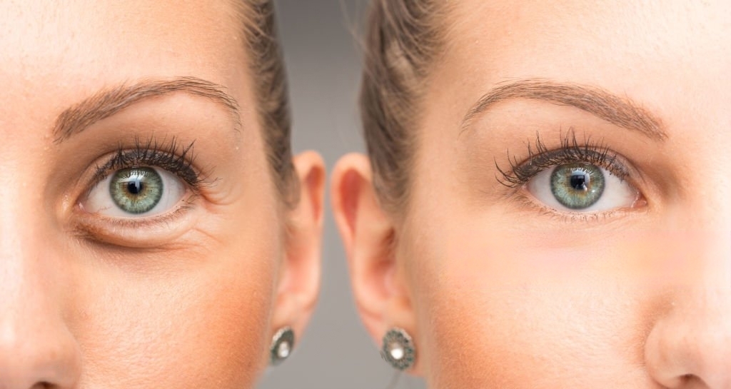eyelid